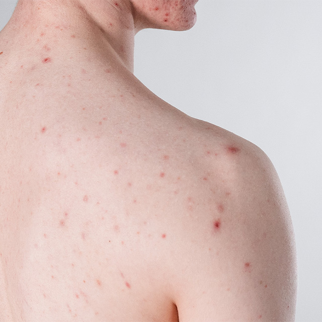 Image of boy with severe acne on the back.
